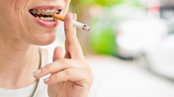 تاثیر سیگار بر ایمپلنت دندان