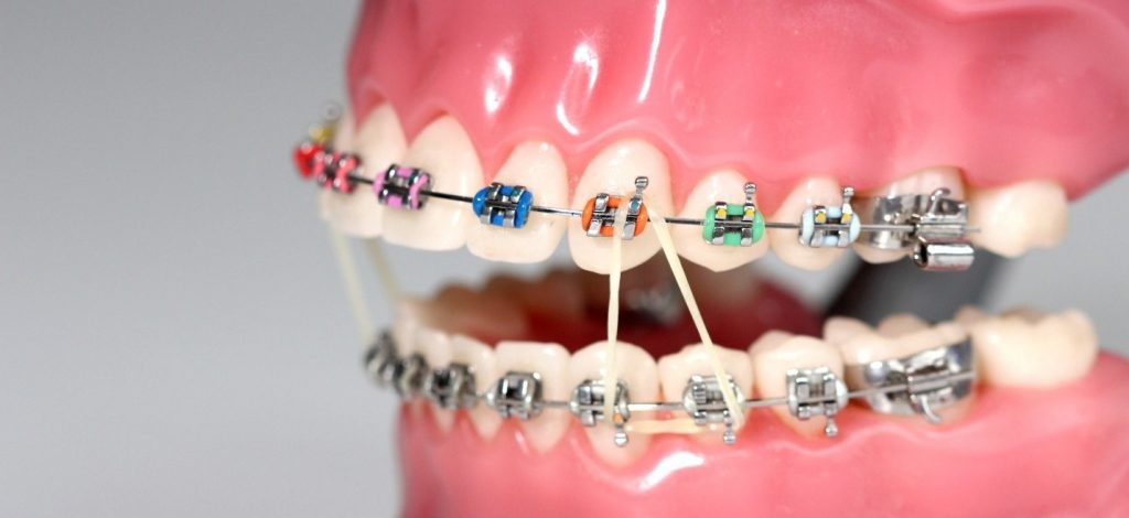 انتخاب بهترین رنگ ها در ارتودنسی دندان رنگی