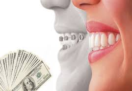 قیمت حدودی لمینت دندان به چه عواملی بستگی دارد؟