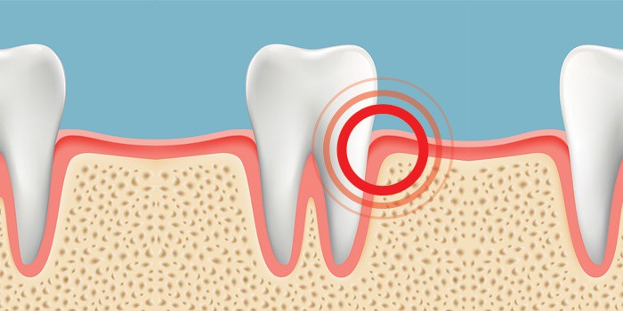 ورم لثه چیست و علل آن کدامند؟