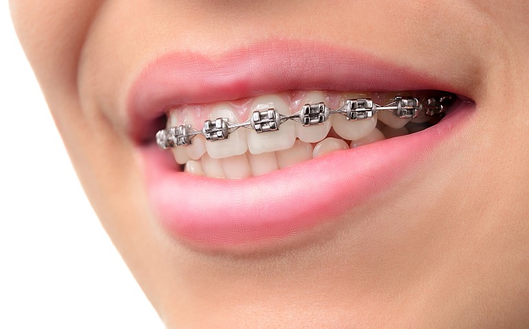 ارتودنسی سریع دندان چگونه انجام میشود ؟