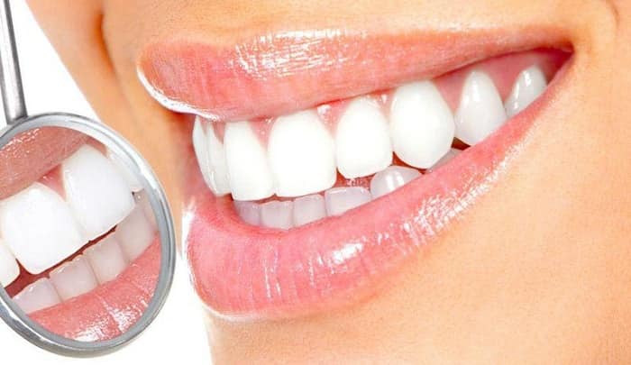 لمینت دندان با تراش برای چه دندان هایی انجام می شود؟