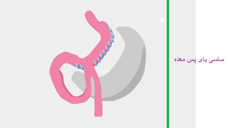مراحل جراحی اسلیو معده