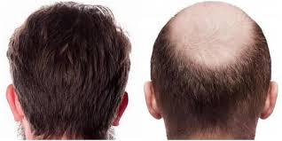 چشم انداز بلند مدت در پیوند مو چیست؟