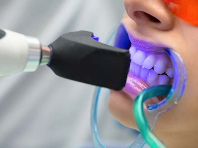 هزینه بلیچینگ دندان چقدر است؟