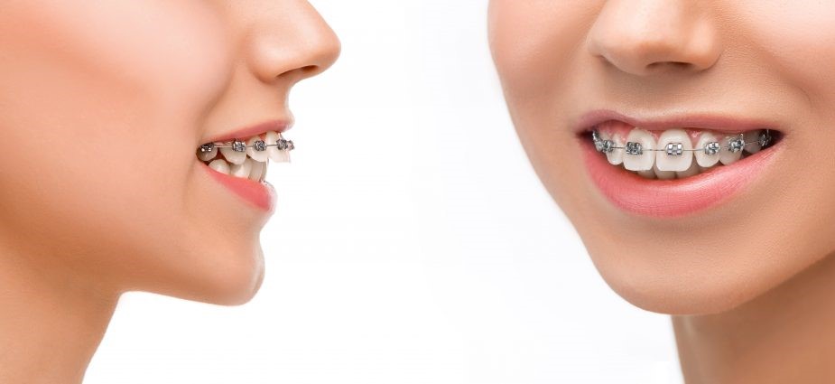 علت بیرون زدگی دندان های بالا چیست و ارتودنسی چگونه آن را درمان می کند؟