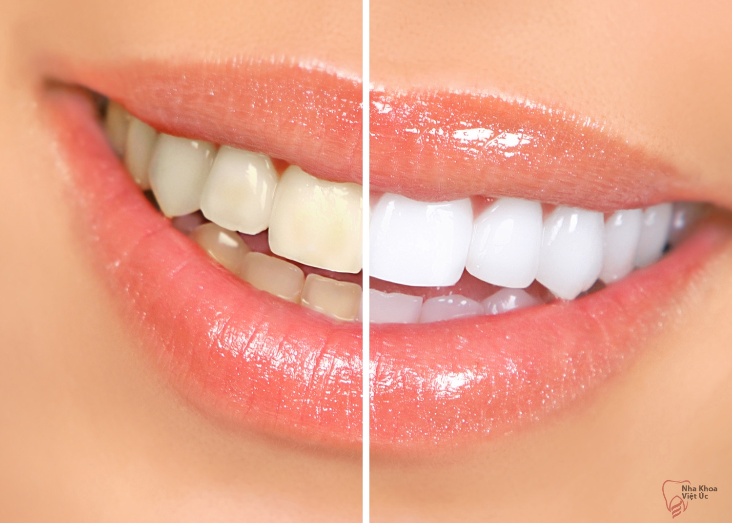 پاسخ به سوالات رایج درباره ونیر کامپوزیت دندان