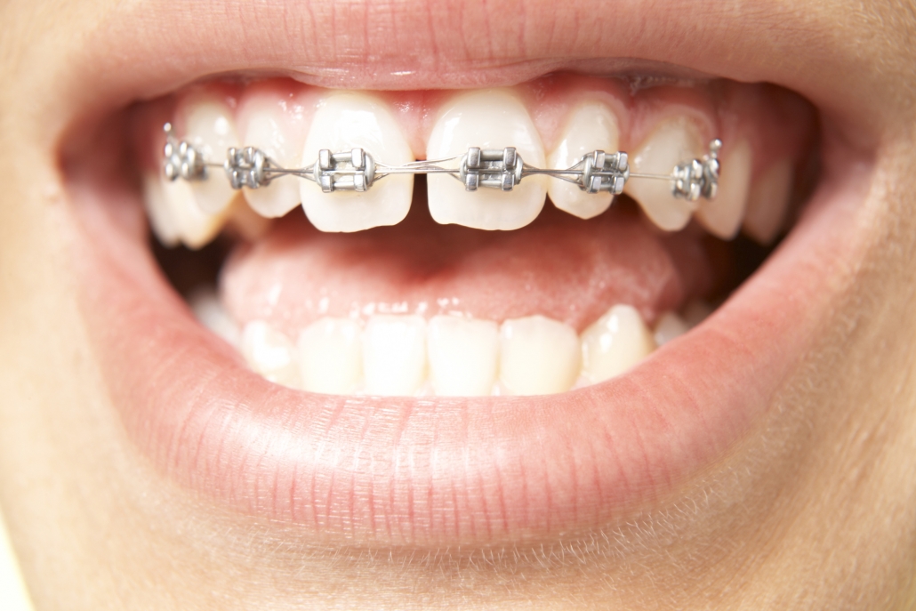 تفاوت های ایجاد شده در ارتودنسی دندان قبل و بعد