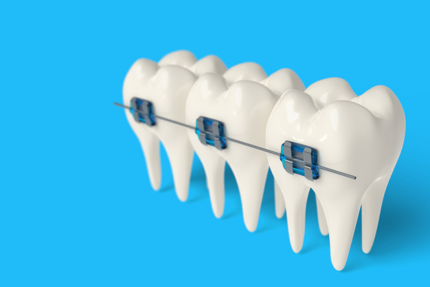 آشنایی با مهمترین روش های سفید کردن دندان ها پس از ارتودنسی