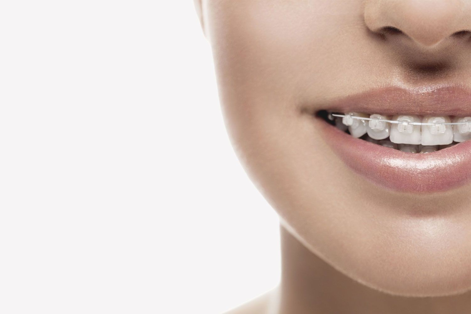 ارتودنسی نامرئی و ارتودنسی سیمی: کدام باعث پوسیدگی دندان می شود؟