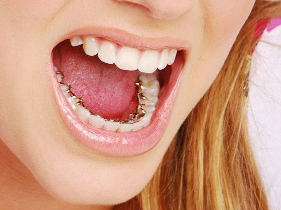 ارتودنسی پشت دندان و مقایسه آن با سایر روش های ارتودنسی