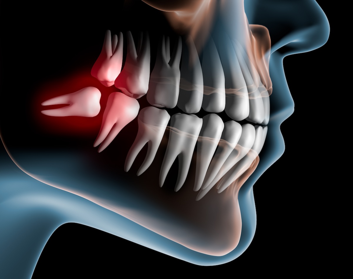 نهفتگی دندان چگونه تشخیص داده می شود؟