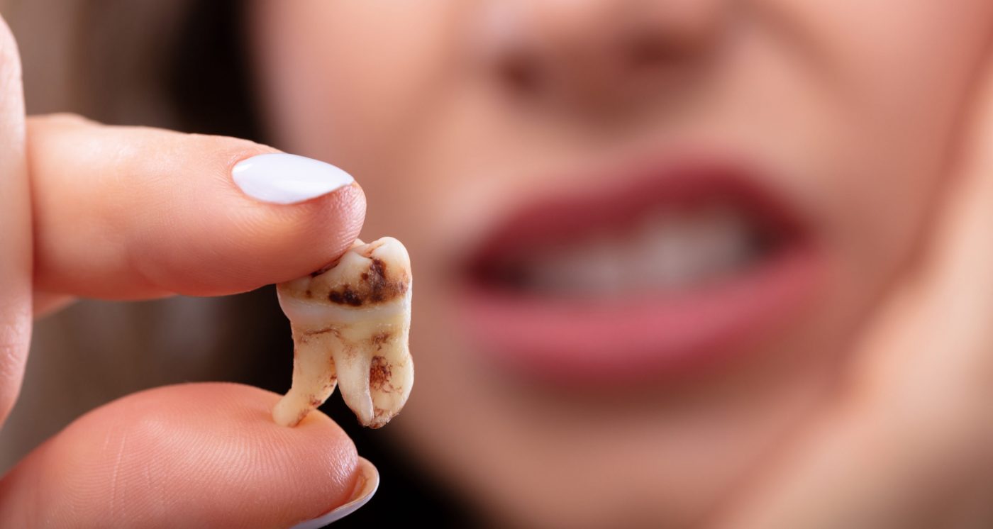 4 روش اصلی و موثر برای درمان دندان درد در خانه