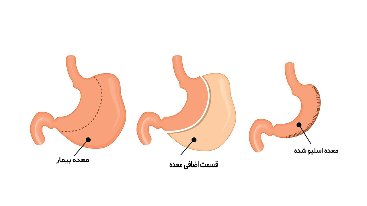 اهمیت جراحی لاغری توسط بهترین متخصص لاغری