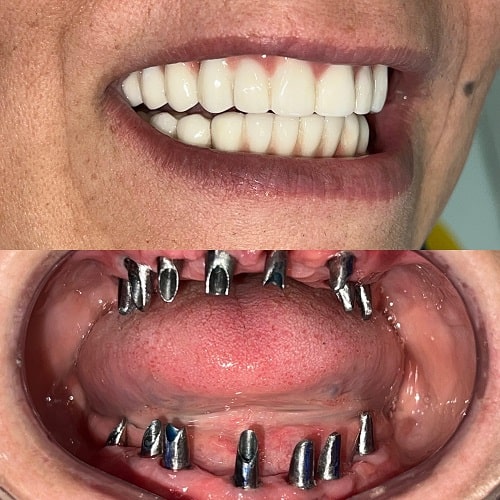 مزایای کاشت ایمپلنت دندان