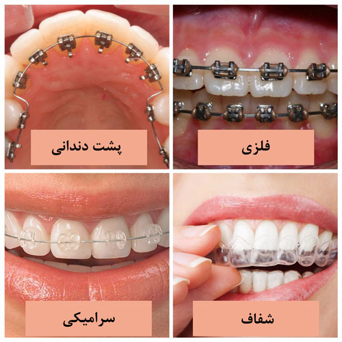 انواع ارتودنسی دندان و انتخاب بهترین روش