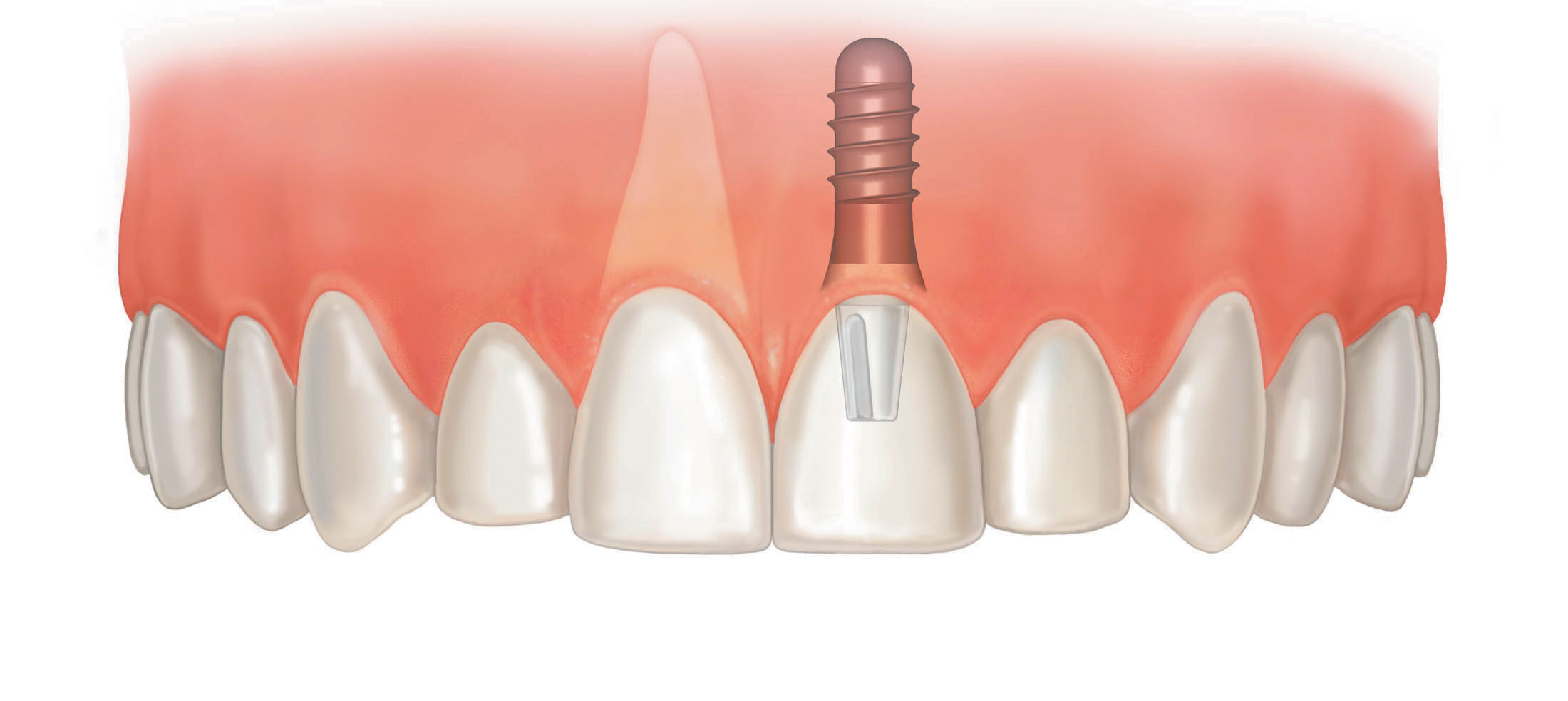 بهترین متخصص ایمپلنت دندان: معیارهای انتخاب و ویژگی‌های یک متخصص خوب