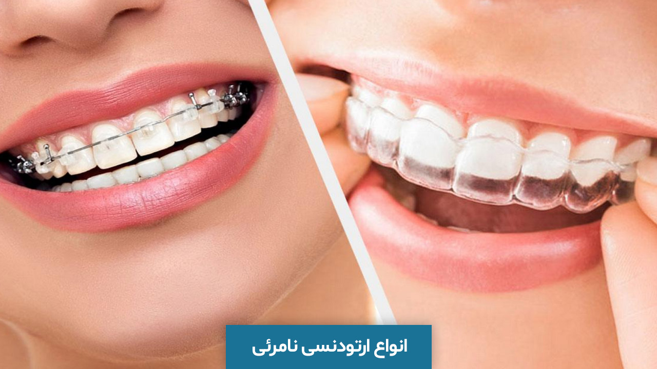 یک بار برای همیشه با مهم ترین انواع ارتودنسی دندان آشنا شویم