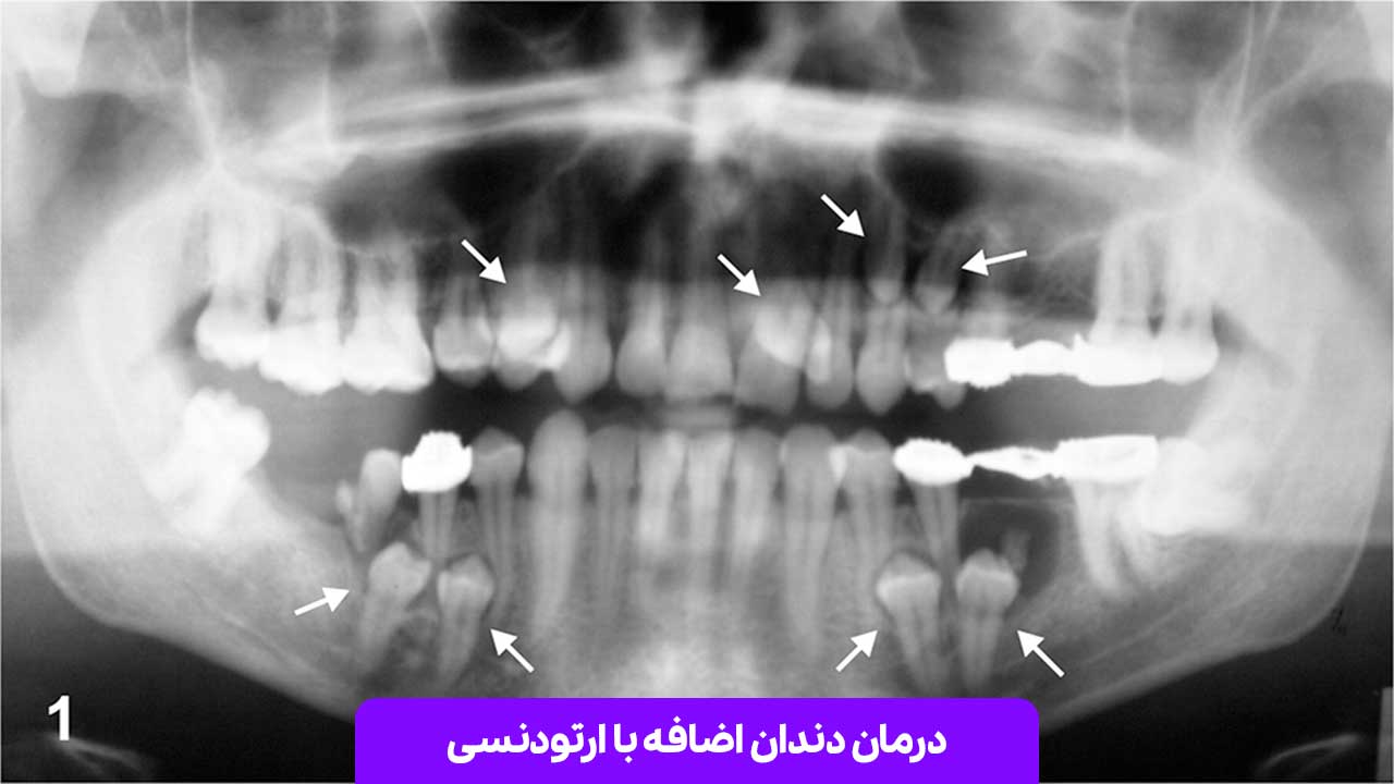 درمان دندان اضافه با ارتودنسی: راهی موثر برای بهبود ظاهر و عملکرد دندان‌ ها