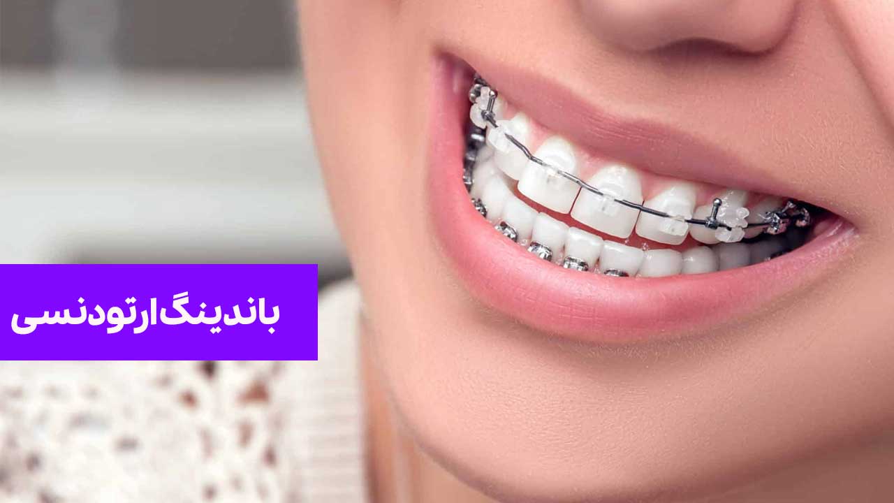 باندینگ ارتودنسی: همه چیز درباره مزایا، مراحل و مراقبت ‌ها