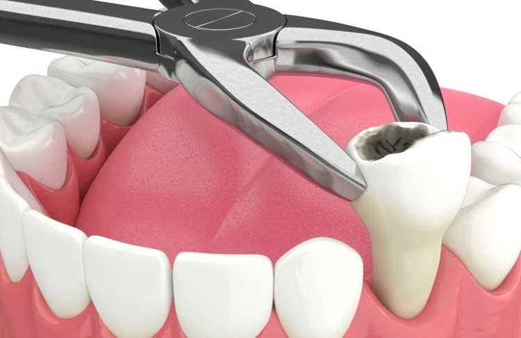 فاصله بین کشیدن دندان و ایمپلنت
