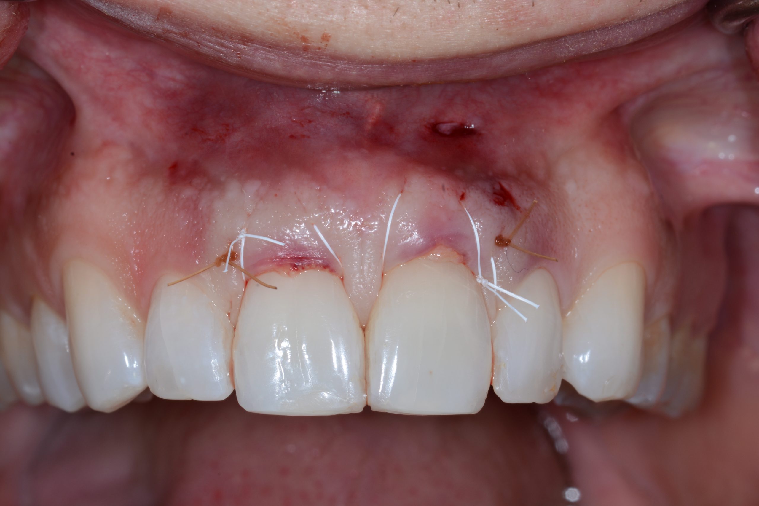 عفونت ایمپلنت دندان: علائم، علل و درمان