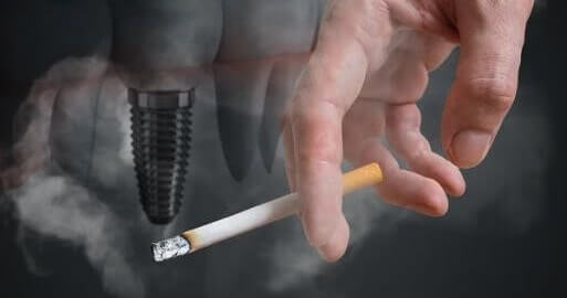 سیگار کشیدن بعد از ایمپلنت دندان