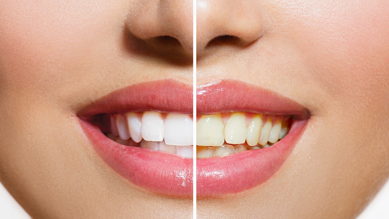 سفید کردن دندان بعد از ارتودنسی با چه روش هایی انجام می شود؟