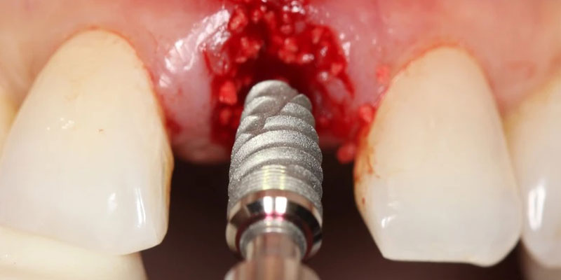 درد ایمپلنت دندان: علل، علائم و درمان