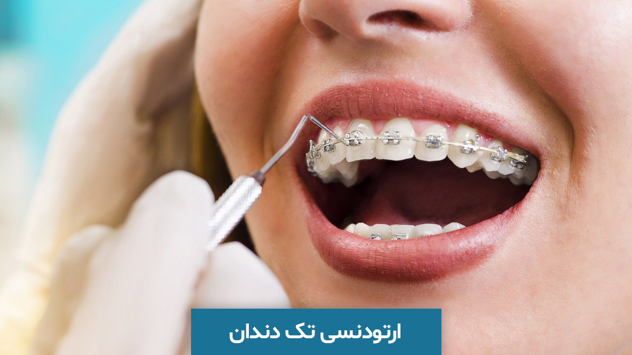 ارتودنسی تک دندان به چه صورت است؟ مزایا و معایب ارتودنسی یک دندان