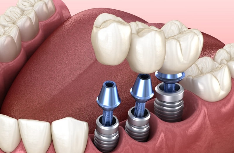 عوارض ایمپلنت دندان، علل، علائم و راه های پیشگیری