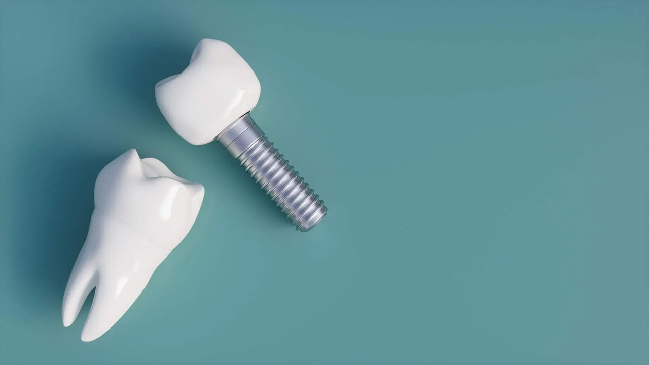 تفاوت بلیچینگ با کامپوزیت دندان؛ کدامیک بهتر است؟