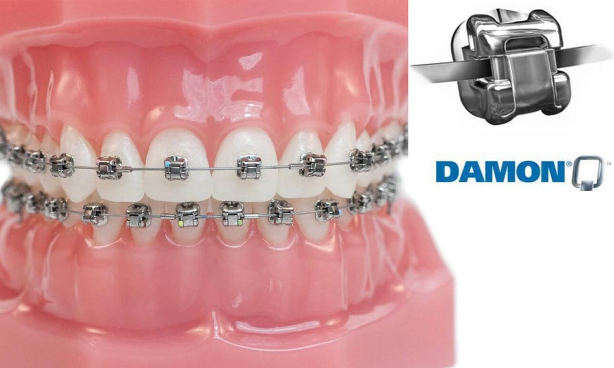 ارتودنسی دیمون: روشی نوآورانه در ترمیم و تنظیم دندان‌ها
