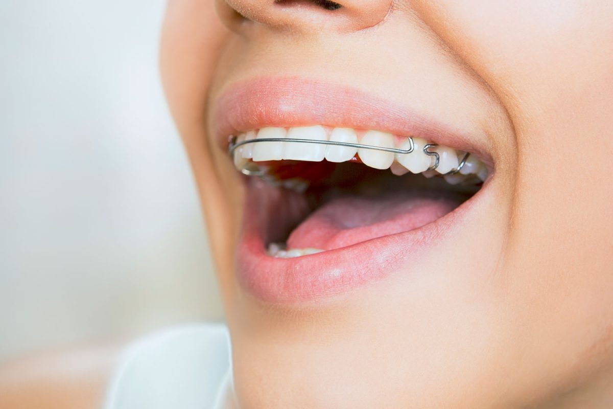 ارتودنسی دندان چیست؟ + همه چیز درباره ارتودنسی
