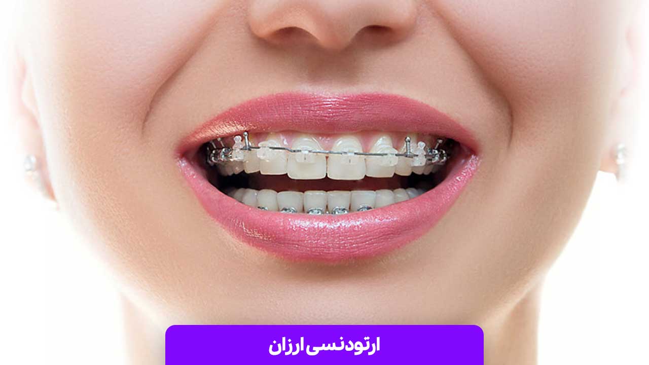 ارتودنسی ارزان؛ راهی مقرون‌ به‌ صرفه برای اصلاح دندان ‌ها