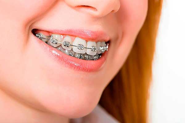 عوارض ارتودنسی دندان: چه چیزی باید انتظار داشته باشید؟