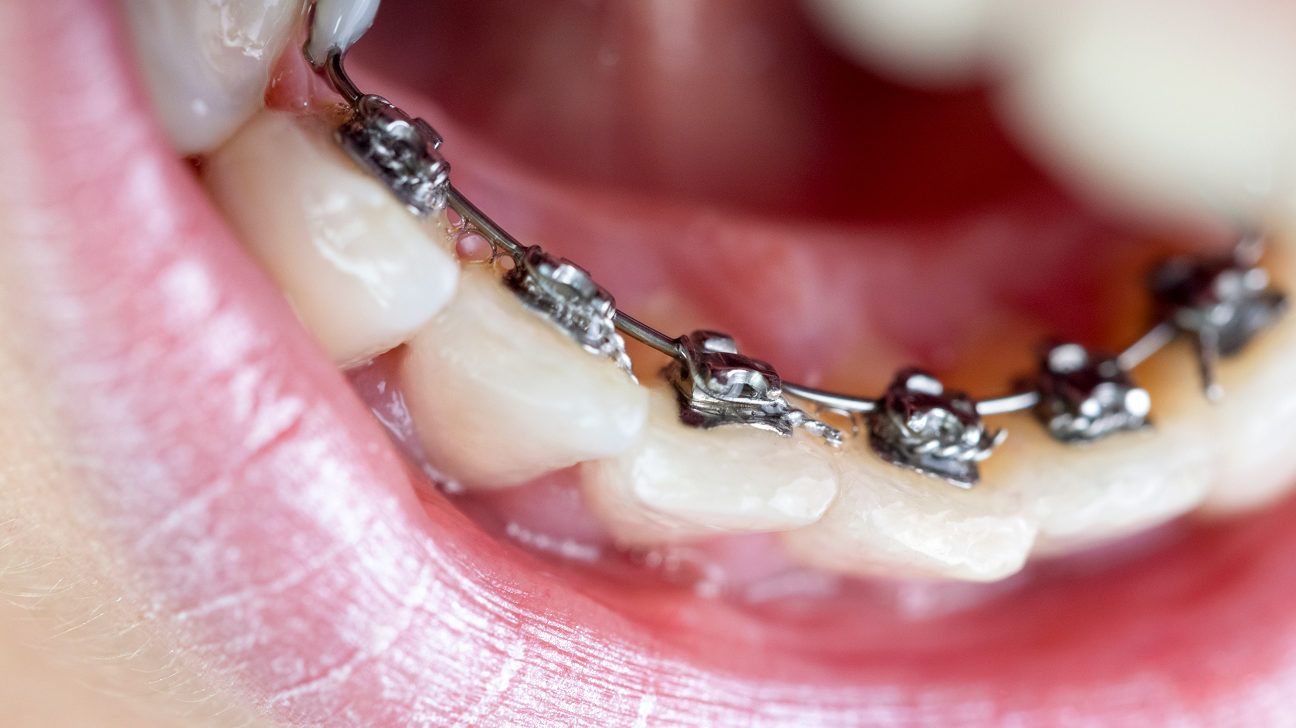 خمیر دندان ارتودنسی؛ بهترین انتخاب برای دندان‌های مرتب و سالم