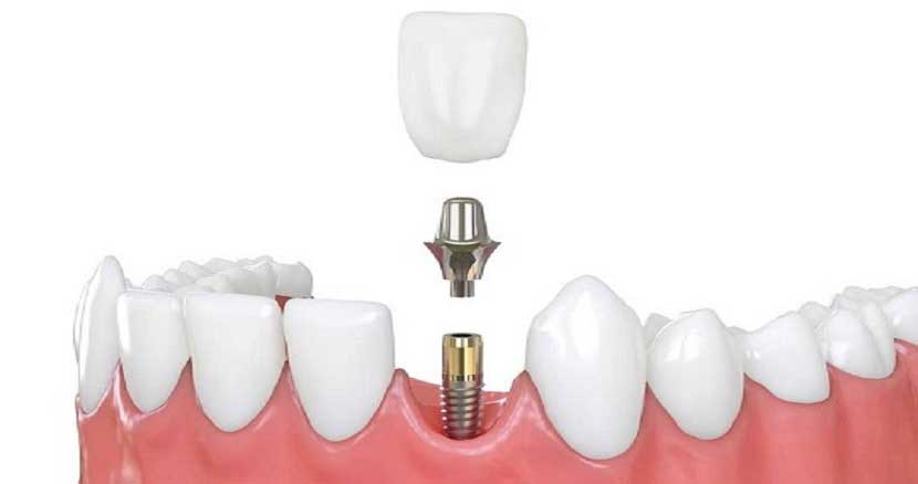 ایمپلنت دندان همراه با پیوند استخوان