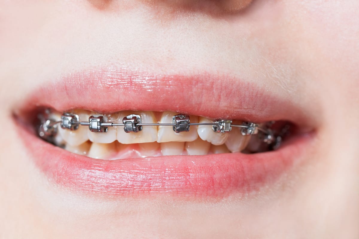 ارتودنسی فک بالا: لبخندی زیبا و دندانی سالم