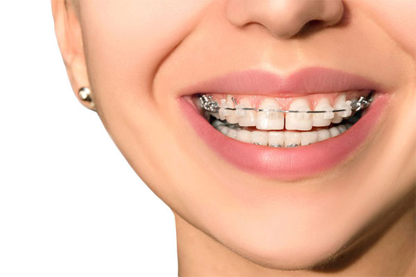 مزایای ارتودنسی دندان: لبخندی زیبا و سالم