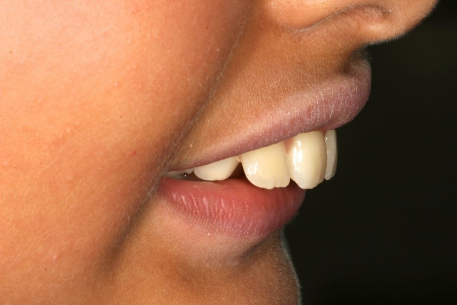 دندان‌های خرگوشی و ارتودنسی: لبخندی زیبا با دندان‌هایی مرتب